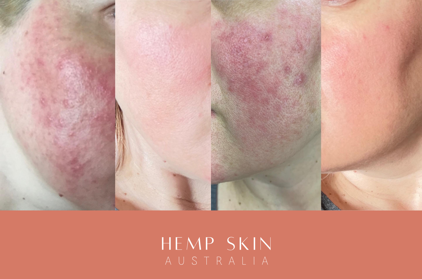 Image showing improvement of rosacea on sensitive skin with oils.